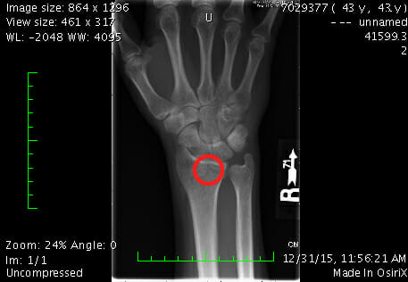 If you look carefully, you can see the hairline fractures in the distal end of my radius, circled in red. It may not look like much, but trust me... it hurt.